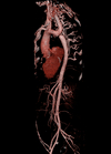 CTA CT-Angiographie einer Aortenisthmusstenose